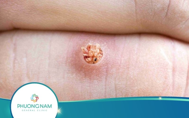 Top 5 Cách Trị Mụn Cóc Tại Nhà Hiệu Quả Nhất