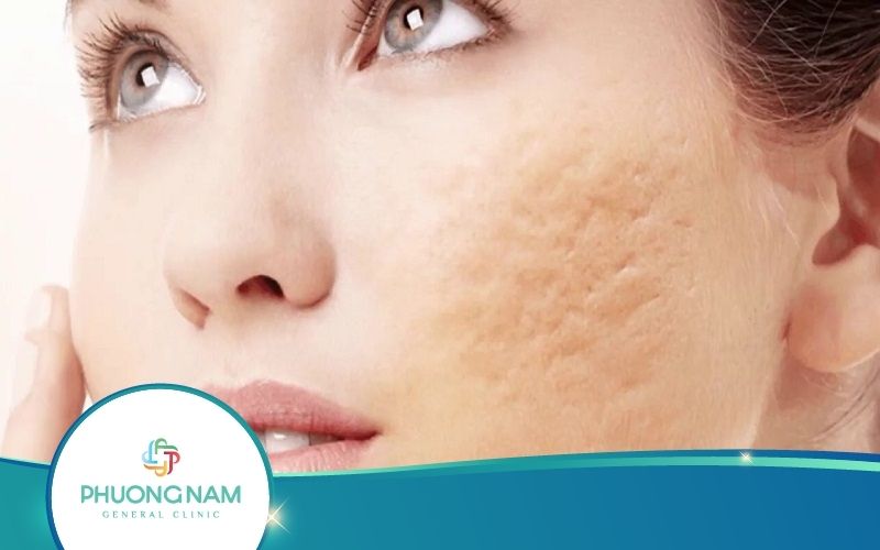 Top 10 Cách Trị Sẹo Lõm Lâu Năm Trên Mặt Tại Nhà