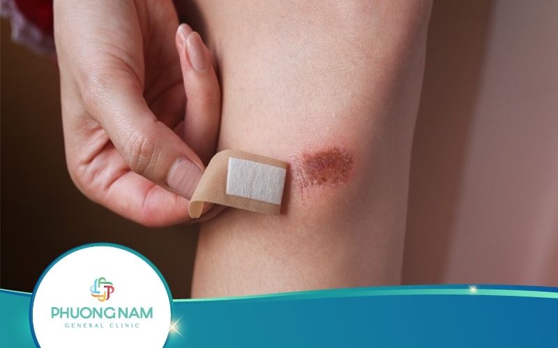 [Phải Biết] Cách Làm Mau Lành Vết Thương Té Xe Tại Nhà