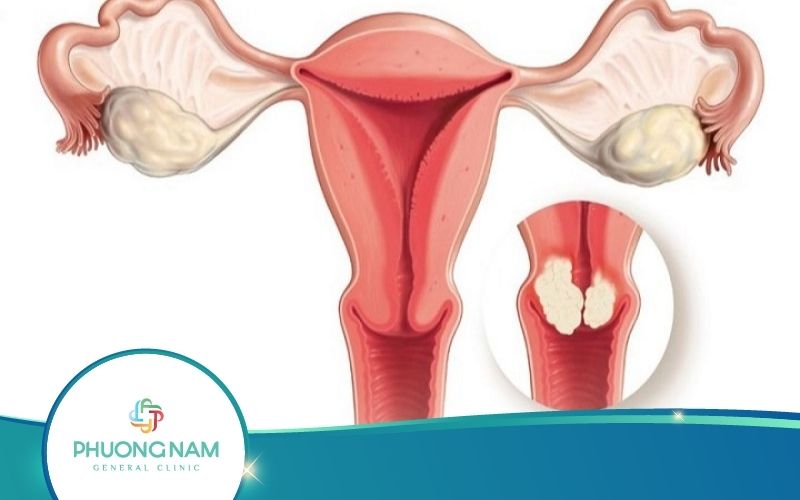 Nhân Xơ Tử Cung Có Ảnh Hưởng Tới Thai Nhi Và Mẹ Bầu Không?