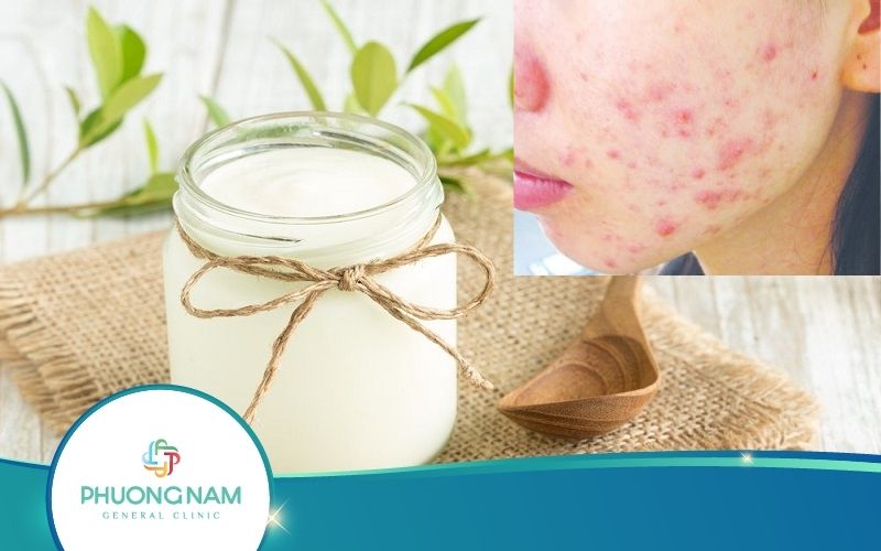 Top 5 Cách Trị Dị Ứng Da Mặt Bằng Sữa Chua