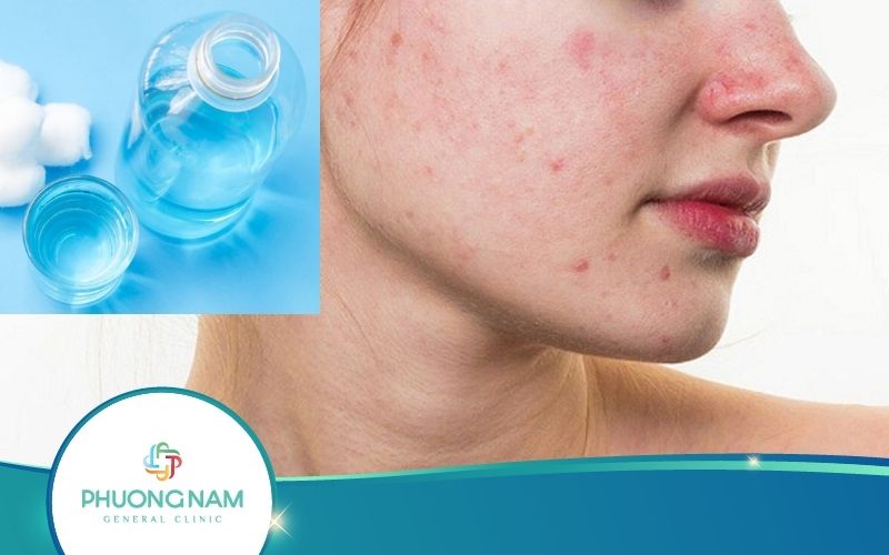 Trị Mụn Bằng Oxy Già Hiệu Quả Bất Ngờ – Thực Hư Ra Sao?