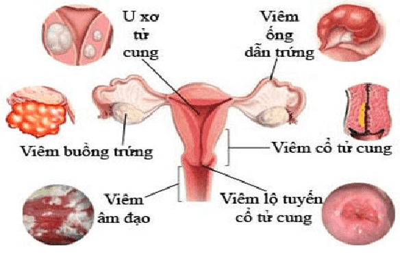 Nguyên nhân gây bệnh phụ khoa
