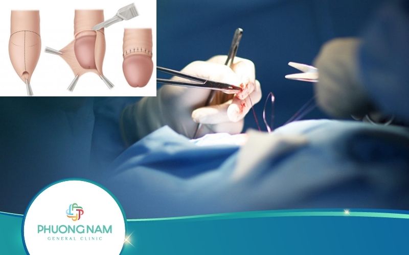 Cắt Bao Quy Đầu Bao Lâu Thì Lành, Bao Lâu Thì Hồi Phục?