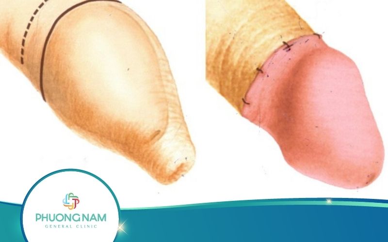 Hình Ảnh Sau Khi Cắt Bao Quy Đầu Ra Sao?