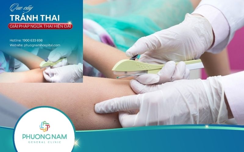 Tổng Hợp Tất Tần Tật Về Que Cấy Tránh Thai