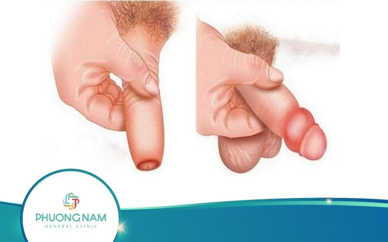 Tuột Bao Quy Đầu Bị Sưng Phồng Có Sao Không? Chữa Thế Nào?