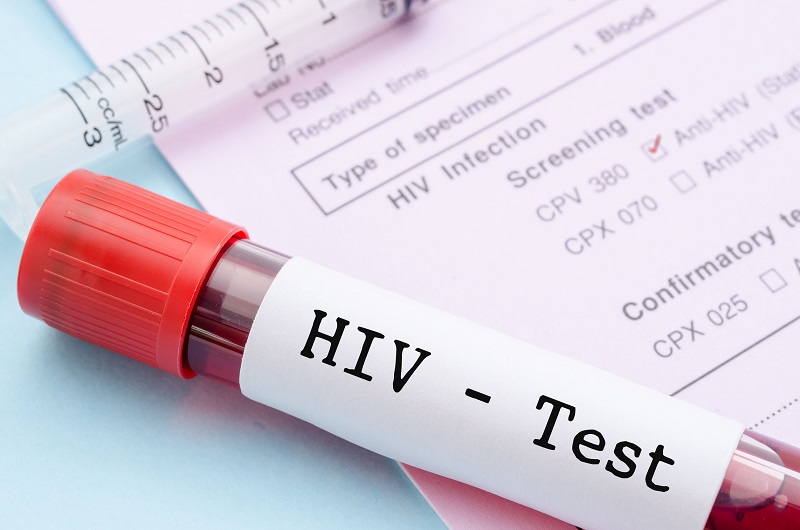 Khám sức khỏe công ty có xét nghiệm HIV