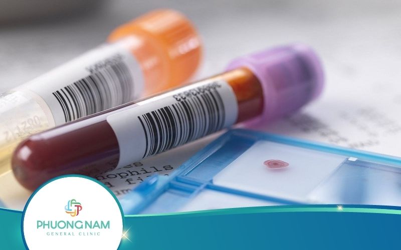 Xét Nghiệm Bilirubin Là Gì? Cách Thức Hiện Ra Sao?
