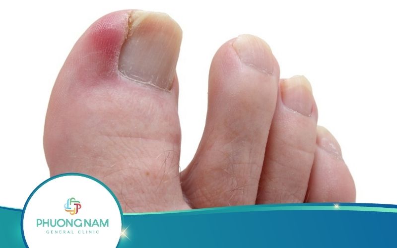 Ngón Chân Cái Bị Sưng Đau Mưng Mủ Do Đâu?