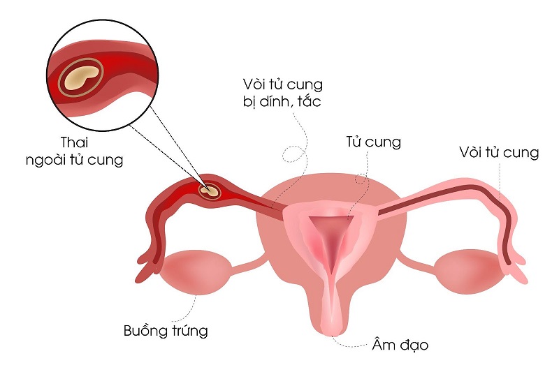 Thai ngoài tử cung là gì?