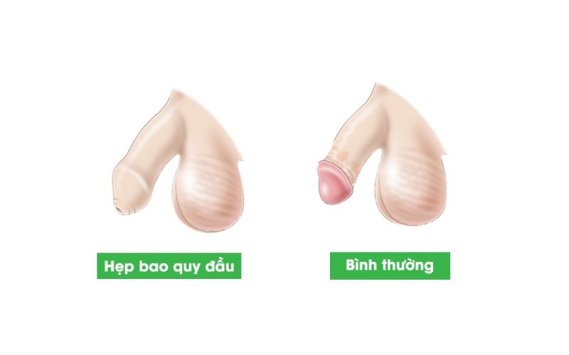 Hình ảnh trẻ sơ sinh bị hẹp bao quy đầu 