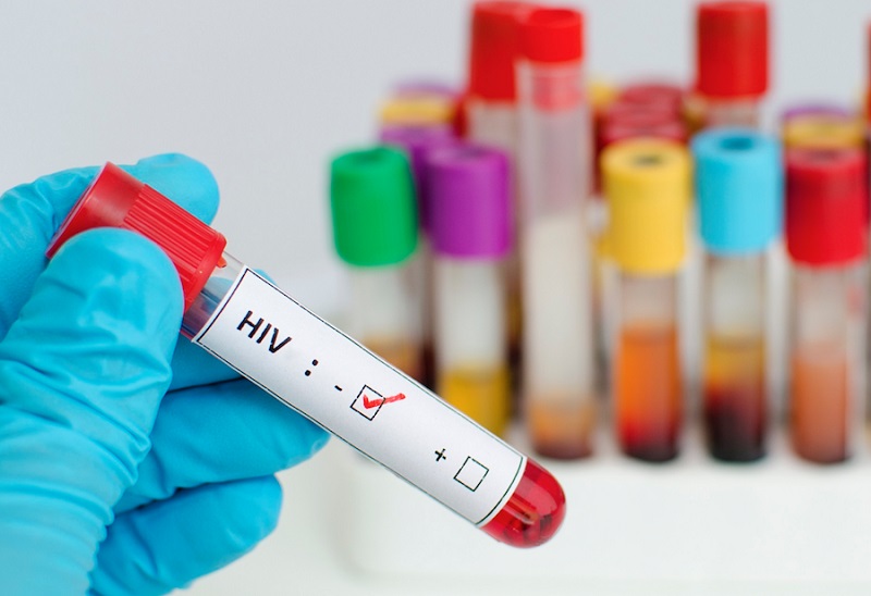 Xét nghiệm khẳng định HIV là gì? 