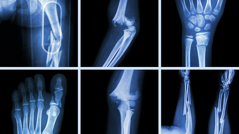 Khái niệm về chụp X quang cổ tay