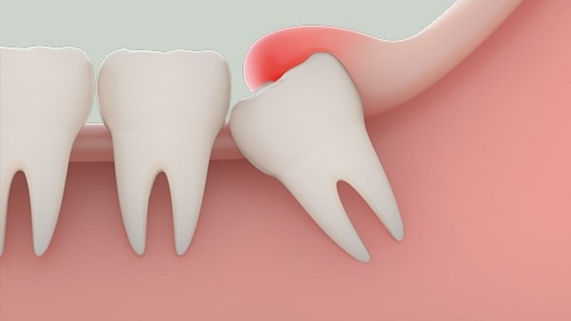 Răng khôn là răng gì?