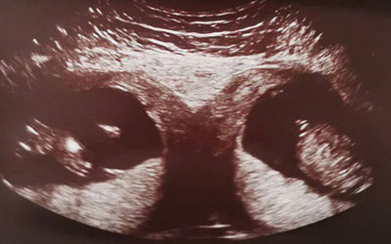 Mấy tuần siêu âm thì biết thai đôi?
