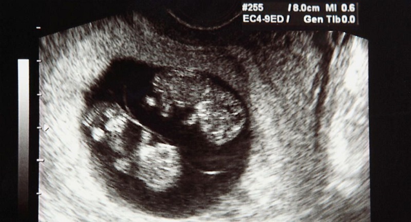 Hình ảnh siêu âm thai đôi 5 tuần