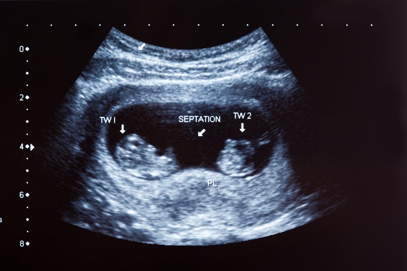 Hình ảnh siêu âm thai đôi 6 tuần