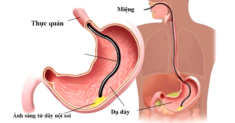 Chỉ định nội soi thực quản dạ dày tá tràng đối với ai?