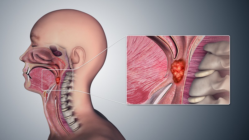 Nội soi vòm họng có phát hiện ung thư không? 