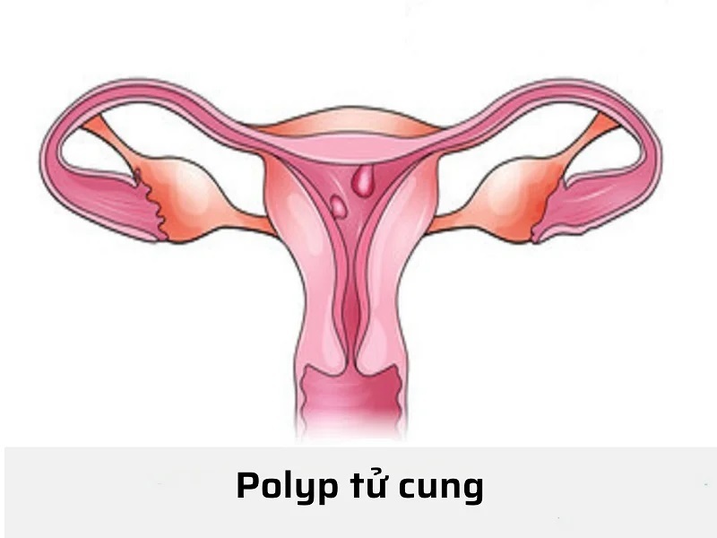 Polyp buồng tử cung là gì?