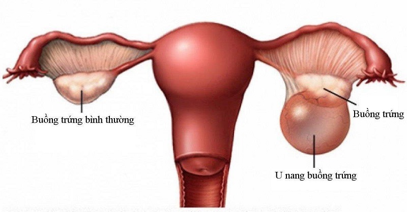 Tổng quan về u nang buồng trứng