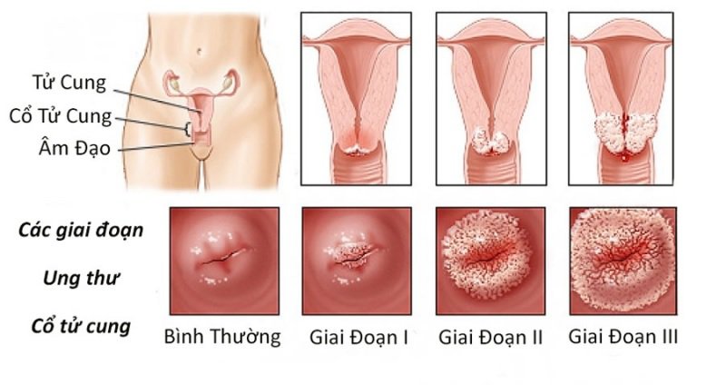 Bệnh phụ khoa thường gặp khi mãn kinh