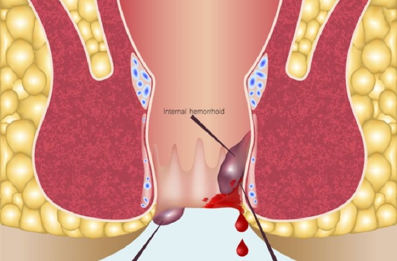 Virus HPV có thể gây nên những loại ung thư nào?