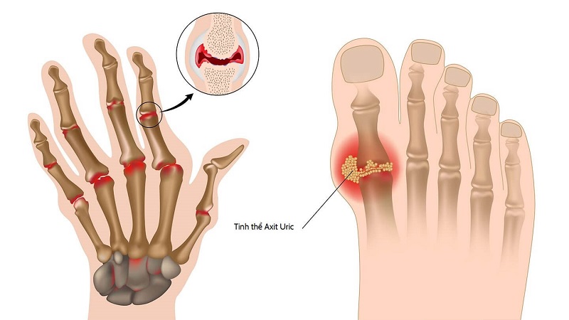 Nguyên nhân gây ra bệnh gout thường liên quan đến việc tạo ra quá nhiều acid uric hoặc chức năng loại bỏ acid uric trong máu bị giảm.