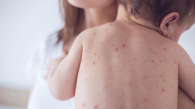 Người bị nhiễm bệnh rubella sẽ xuất hiện các nốt ban đỏ, ban đầu nổi ở mặt sau đó lan khắp toàn thân.