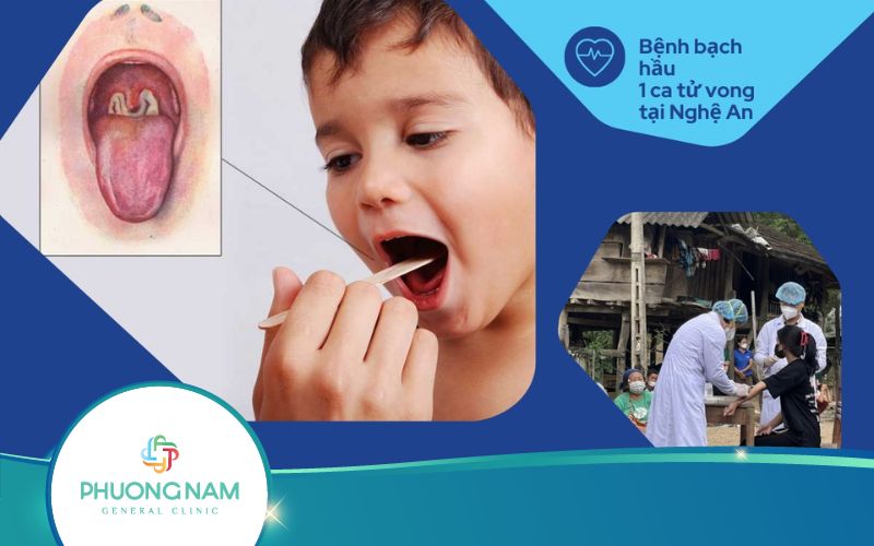 [Cảnh báo] Dịch Bệnh Bạch hầu năm 2024 – 1 ca tử vong tại Nghệ An ngày 08/07
