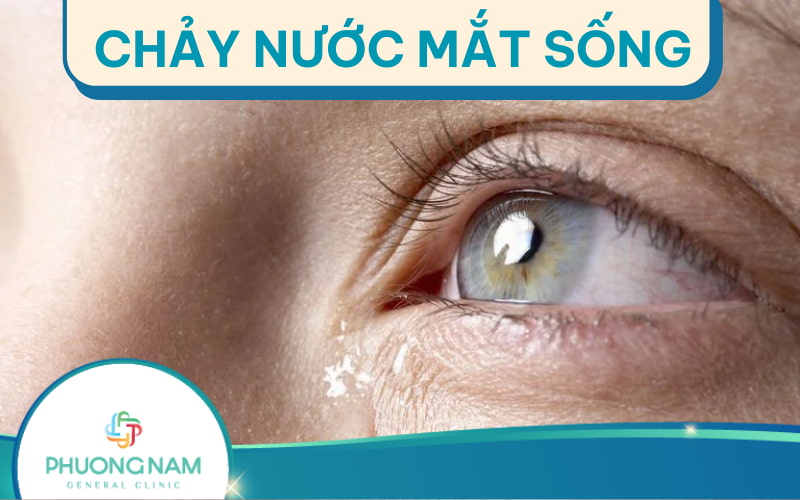 Chảy nước mắt sống: Nguyên nhân, triệu chứng, điều trị và phòng ngừa
