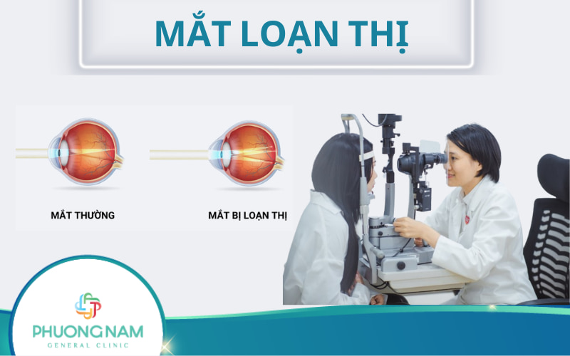 Mắt loạn thị: Nguyên nhân, dấu hiệu, chẩn đoán và điều trị