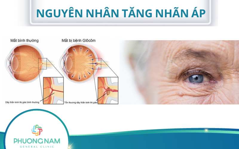 07 Nguyên nhân tăng nhãn áp bạn cần lưu ý