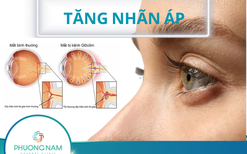 Tăng nhãn áp (IOP): Nguyên nhân, triệu chứng và cách phòng ngừa