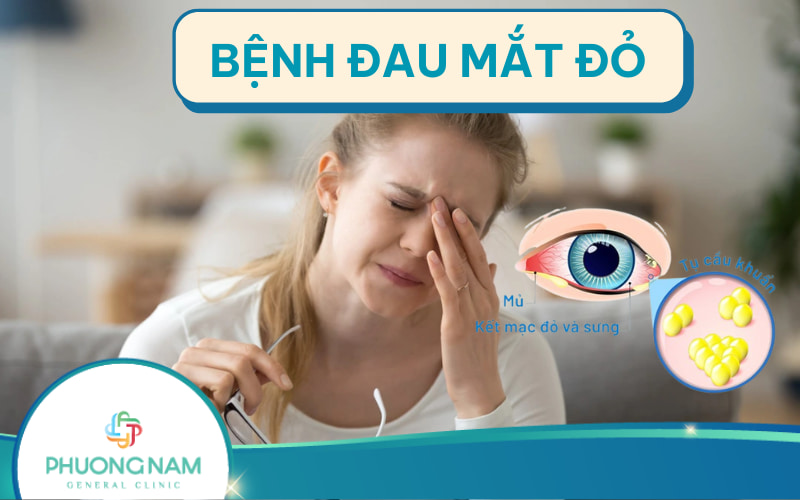 Bệnh đau mắt đỏ: Nguyên nhân, dấu hiệu và cách điều trị