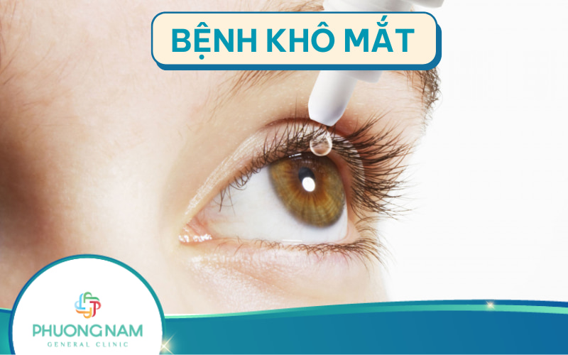 Bệnh khô mắt: Nguyên nhân, chẩn đoán và cách điều trị