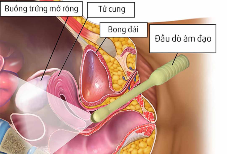 Siêu âm đầu dò âm đạo là phương pháp được sử dụng rộng rãi trong chẩn đoán các bệnh sản, phụ khoa