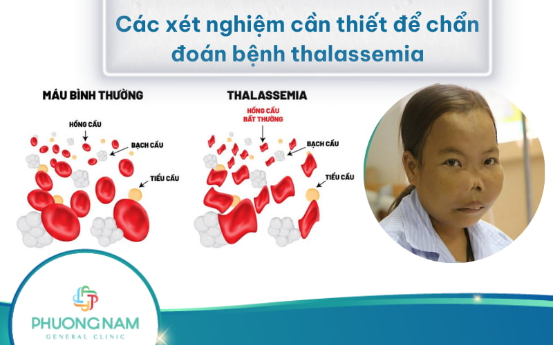 Các xét nghiệm cần thiết để chẩn đoán bệnh Thalassemia