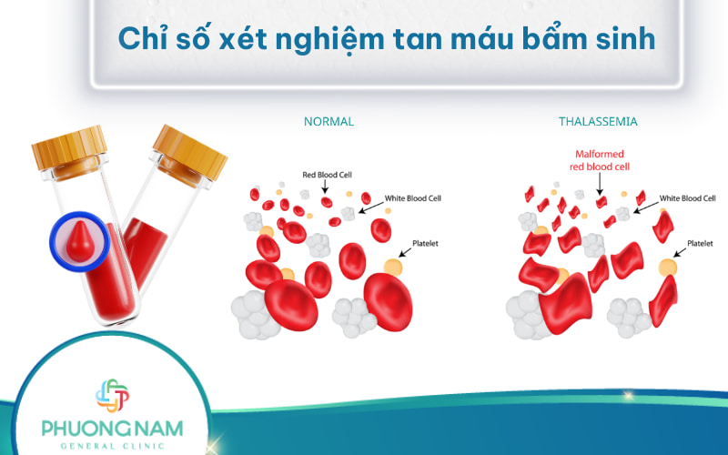 Ý nghĩa các Chỉ số xét nghiệm tan máu bẩm sinh chi tiết