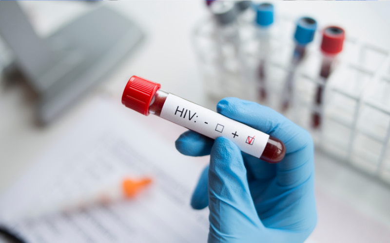 Xét nghiệm HIV dương tính: Có nghĩa là bạn đã nhiễm virus HIV, gây ra hội chứng suy giảm miễn dịch mắc phải (AIDS).