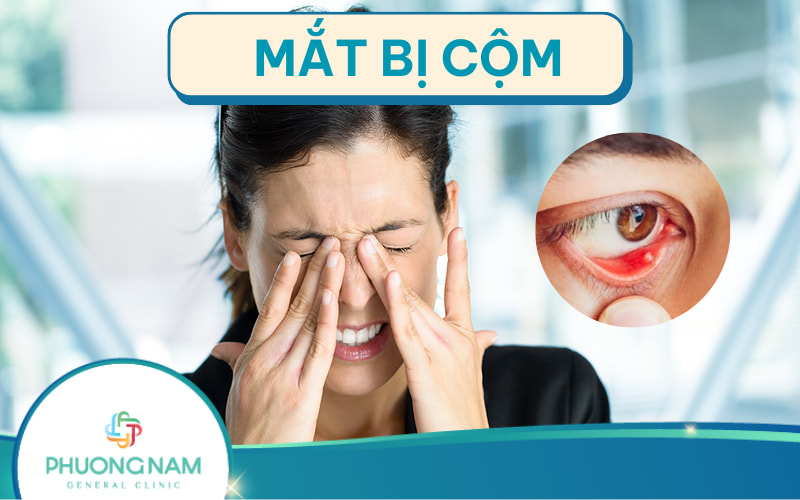 Mắt bị cộm: Nguyên nhân, điều trị và cách phòng tránh