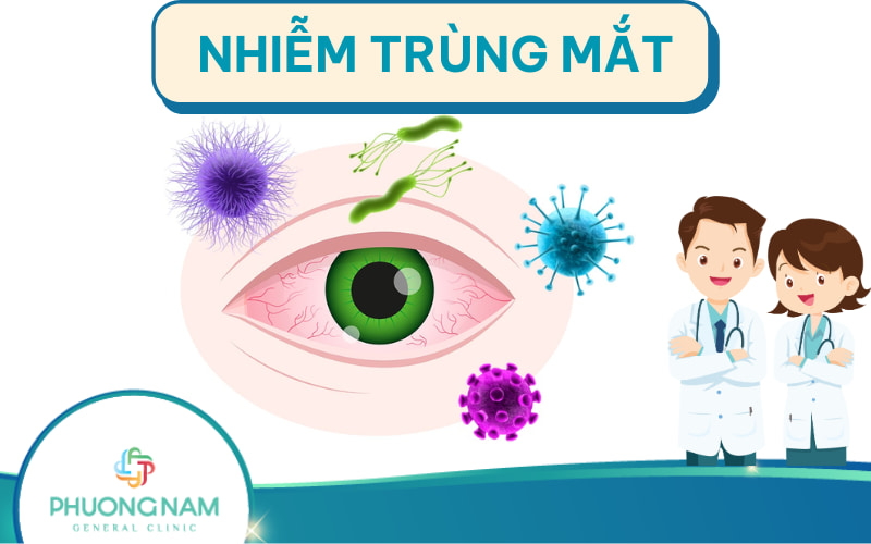 Nhiễm trùng mắt: Nguyên nhân, triệu chứng và cách điều trị