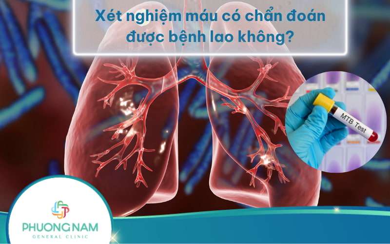 Xét nghiệm máu có chẩn đoán được bệnh lao không? Và ưu nhược điểm của xét nghiệm máu
