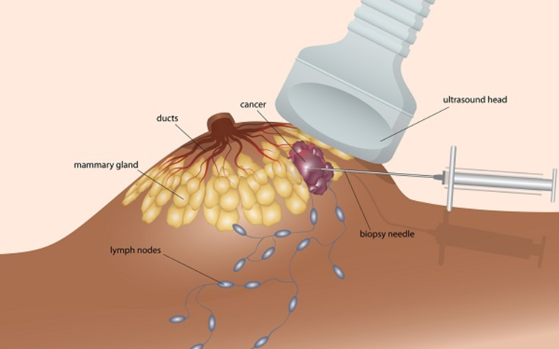 Sinh thiết vú nhằm phát hiện sớm và điều trị kịp thời các bệnh lý tiềm ẩn, bao gồm ung thư vú. 