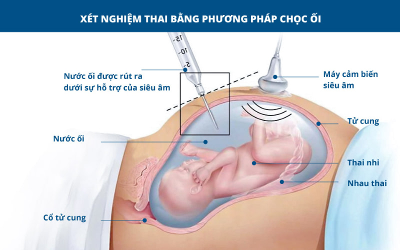 Chọc ối xét nghiệm ADN để phân tích các tế bào của thai nhi. 