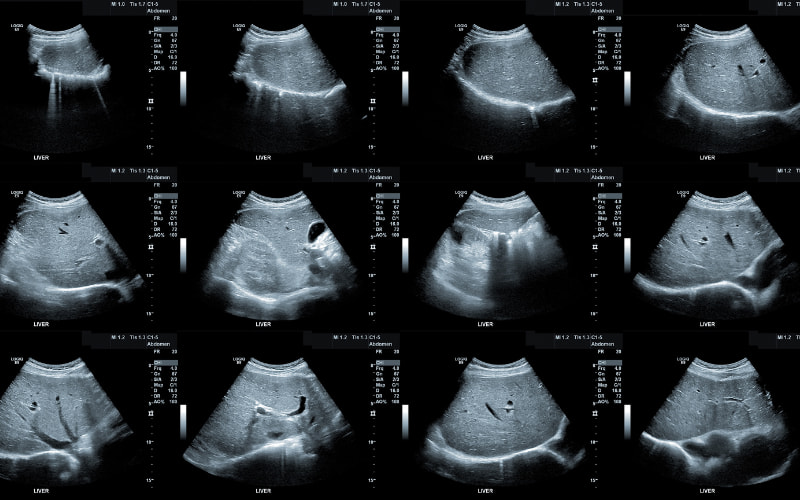 Siêu âm tổng quát là một phương pháp chẩn đoán hình ảnh không xâm lấn