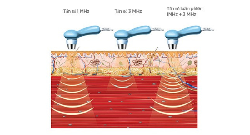 Tác dụng của siêu âm trị liệu 