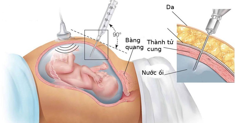 Chọc ối được khuyến cáo thực hiện từ sau 15 tuần