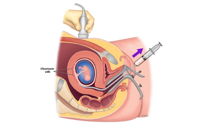 Sinh thiết nhau gai là những kỹ thuật xét nghiệm chẩn đoán trước khi sanh
